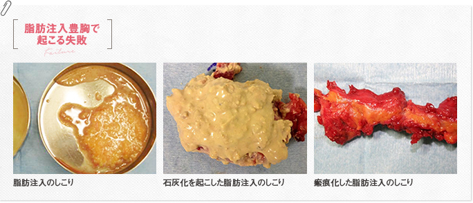 脂肪注入豊胸で起こる失敗