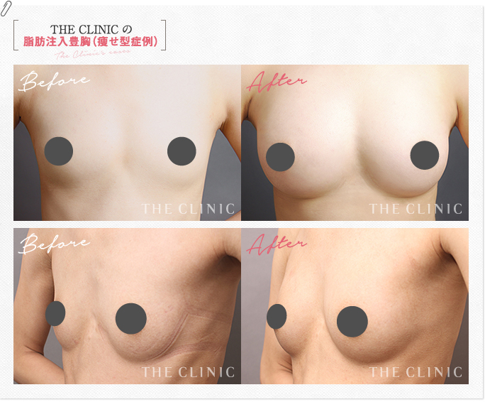 THE CLINIC の脂肪注入豊胸（痩せ型症例）