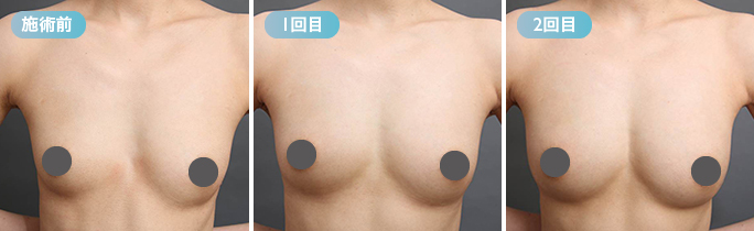 脂肪豊胸症例②