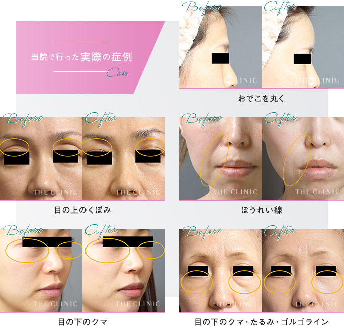 お顔の脂肪注入
