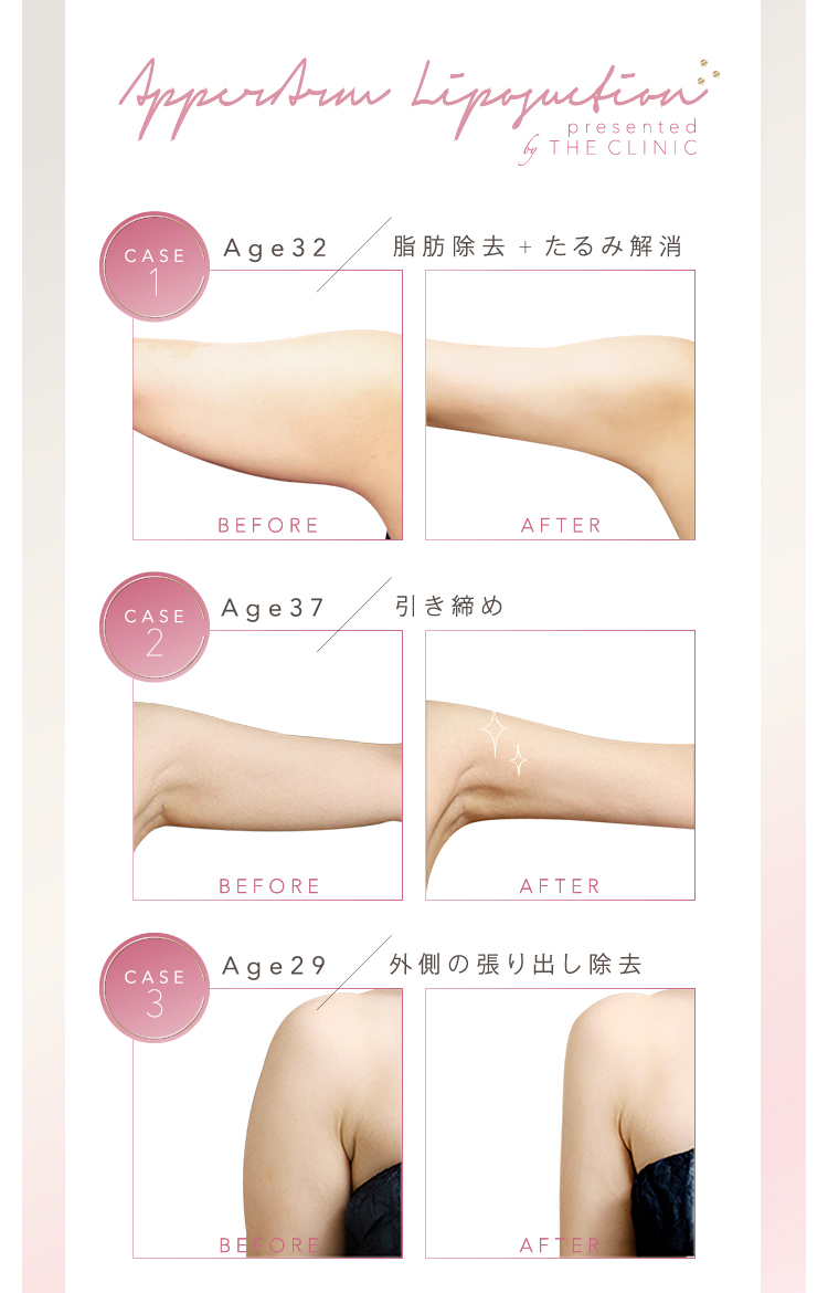 二の腕脂肪吸引の失敗回避ガイド 美容外科の医師監修コラム