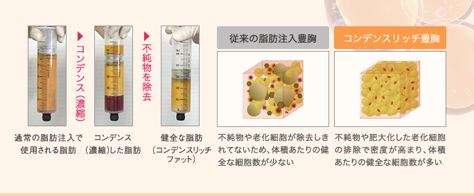 脂肪注入で使用する通常の脂肪とコンデンスリッチの違い