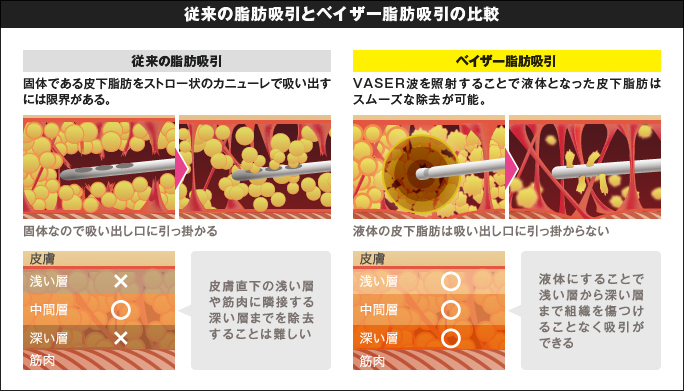 従来の脂肪吸引とベイザー脂肪吸引の比較