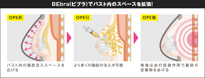乳房拡張機器BEbra(ビブラ)でバスト内のスペースを確保