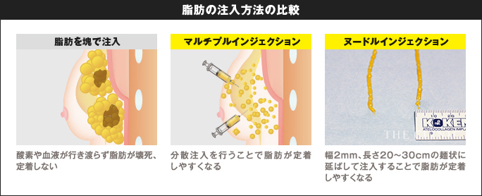 脂肪の定着率を高める技術ヌードルインジェクションとマルチプルインジェクション