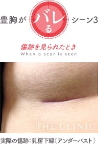 豊胸だとわかるシーン③傷跡を見られたとき