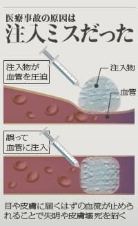 美容整形における医療事故の原因
