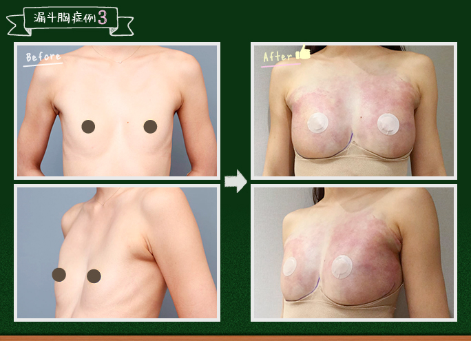 漏斗胸症例3