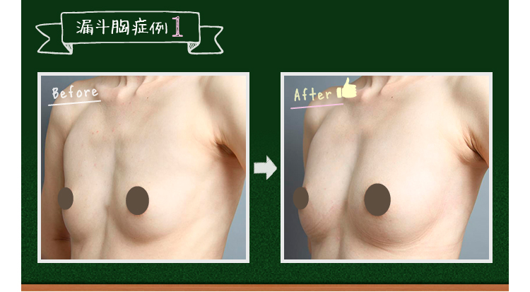 漏斗胸（ろうと胸）の女性必見！～手術なしで胸のくぼみを改善する方法