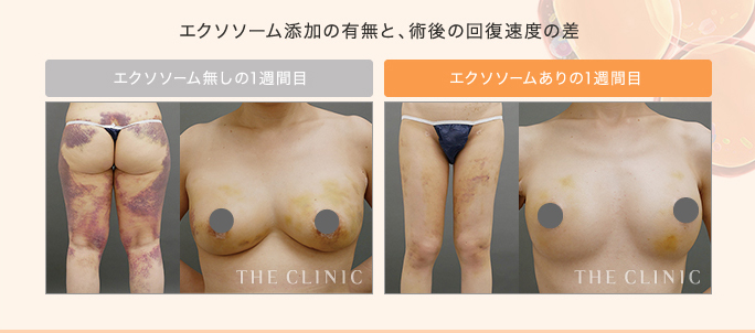 エクソソーム添加の有無とダウンタイムの比較症例