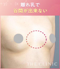 離れ乳で谷間が出来ないバスト症例