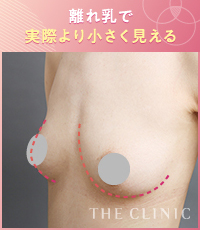 離れ乳で実際よりも小さく見えるバスト症例
