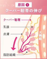 離れ乳の原因①クーパー靭帯の伸び