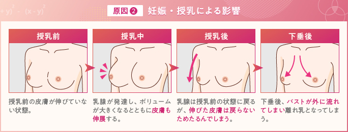 離れ乳の原因②妊娠・授乳による影響