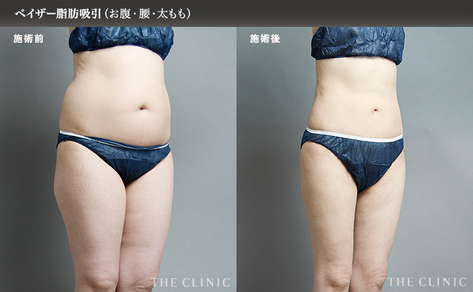 お腹、腰、太ももの脂肪吸引画像