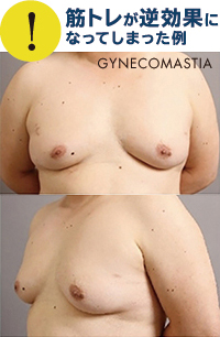 筋トレによって女性化乳房が悪化してしまったケース