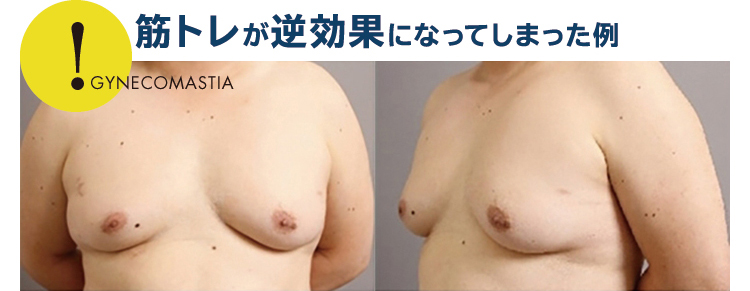 乳首 膨らみ 女性化乳房とは【原因・見分け方・治し方】男性の乳房肥大