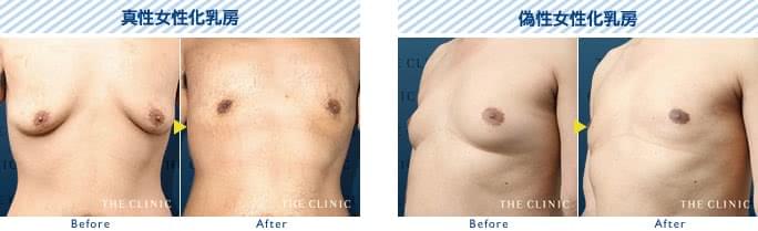 真性女性化乳房と偽性女性化乳房の治療の症例