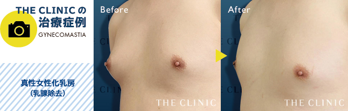 真性女性化乳房治療(乳腺除去)の症例