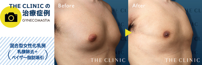 混合型女性化乳房治療(乳腺除去+ベイザー脂肪吸引)の症例
