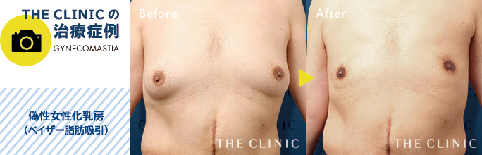 偽性女性化乳房治療(ベイザー脂肪吸引)の症例