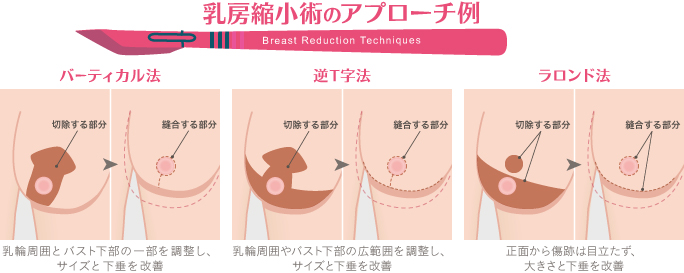 乳房縮小術のアプローチ法３種のラウンドブロック法、逆T字法、ラロンド法