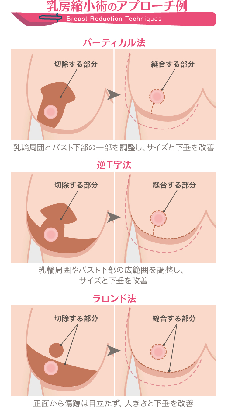 胸 小さく する
