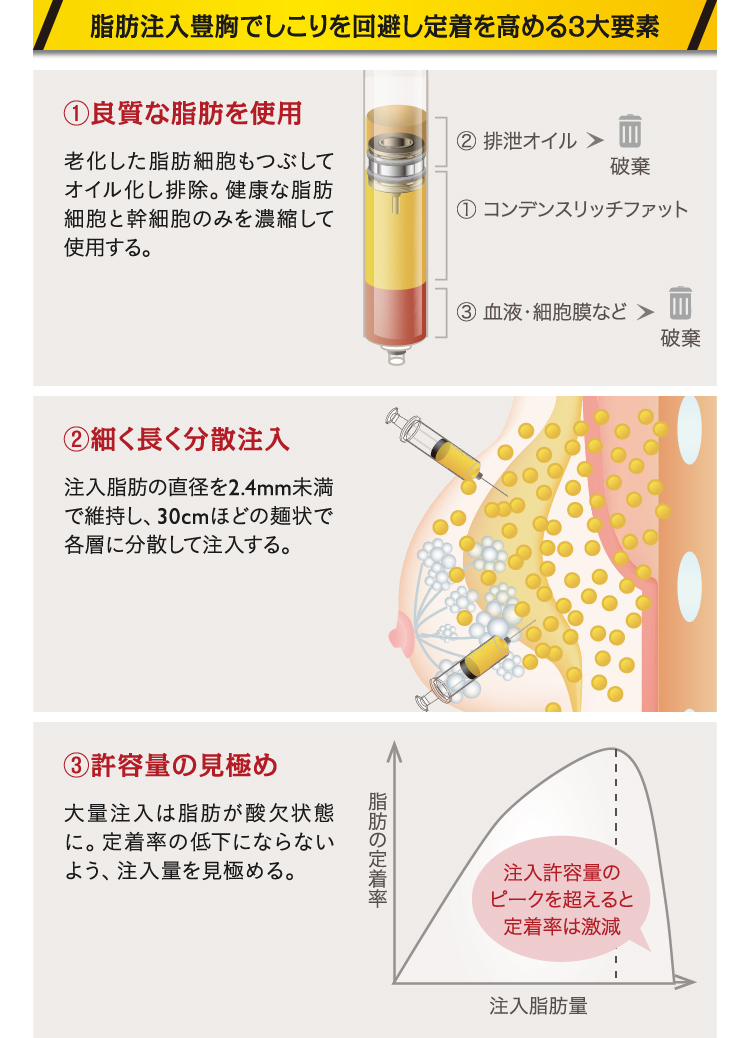 ヒアルロン酸豊胸で後悔するしこりの実態報告！回避策までを医師が解説
