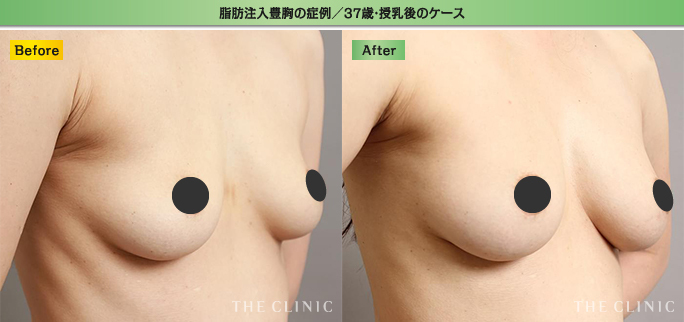 脂肪注入豊胸：37歳授乳後女性の症例