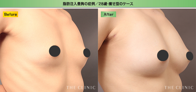 脂肪注入豊胸：28歳痩せ型女性の症例