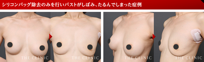 シリコンバッグ除去のみを行いバストがしぼみ、たるんでしまった症例