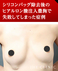 シリコンバッグ除去後のヒアルロン酸注入豊胸で失敗してしまった症例