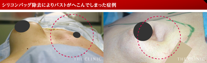 シリコンバッグ除去によりバストがへこんでしまった症例