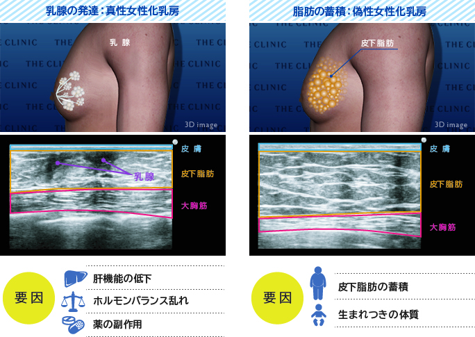 乳腺が肥大する真性女性化乳房と皮下脂肪による偽性女性化乳房それぞれのエコー画像と主な原因