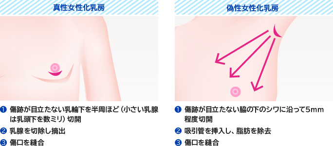 真性女性化乳房と偽性女性化乳房それぞれの傷跡の位置や手術方法