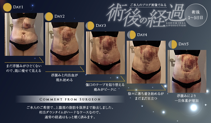 脂肪吸引のブログ画像でみる術後翌日〜5日目