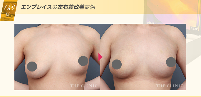 右胸だけクーパー靭帯が切れて垂れてしまった左右差を脂肪注入豊胸とRFタイトニングで改善した症例