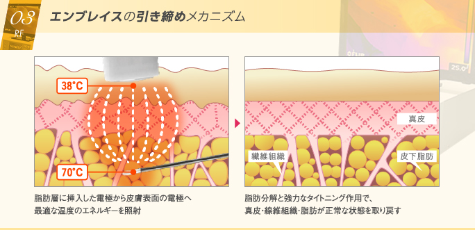 エンブレイスRFがたるみを強力に引き締めるメカニズム