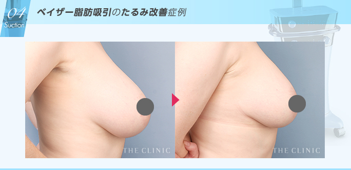 ベイザー脂肪吸引とRFタイトニングによる垂れ乳改善の症例