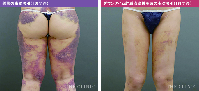 ダウンタイム軽減点滴の有無で異なる脂肪吸引後ダウンタイムの内出血の様子