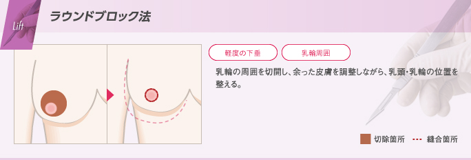 乳輪の周囲を切開し、余った皮膚を調整しながら乳頭・乳輪の位置を整えることで垂れ乳を改善する乳房吊り上げ術のラウンドブロック法