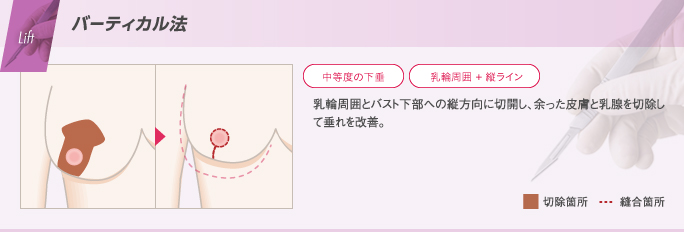 乳輪周囲に加えて、バスト下部へ縦方向に切開して縫い縮め、垂れ乳を改善する乳房吊り上げ術のバーティカル法