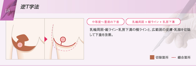 乳輪周囲、バスト下部への縦ライン、乳房下溝に沿った横ラインで切開して縫い縮め、垂れ乳を改善する乳房吊り上げ術の逆T字法