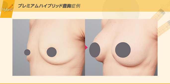 プレミアムハイブリッド豊胸で垂れ乳を改善した症例