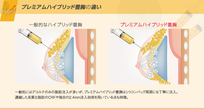 一般的なハイブリッド豊胸とプレミアムハイブリッド豊胸の違い
