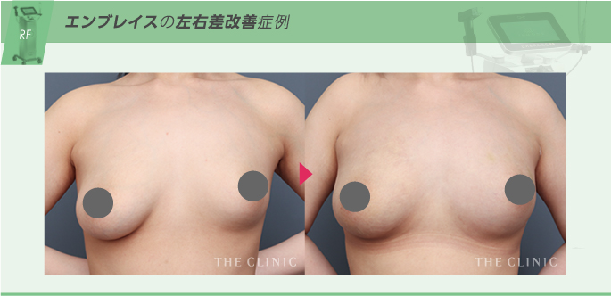 右胸だけクーパー靭帯が切れて垂れてしまった左右差を脂肪注入豊胸とRFタイトニングで改善した症例