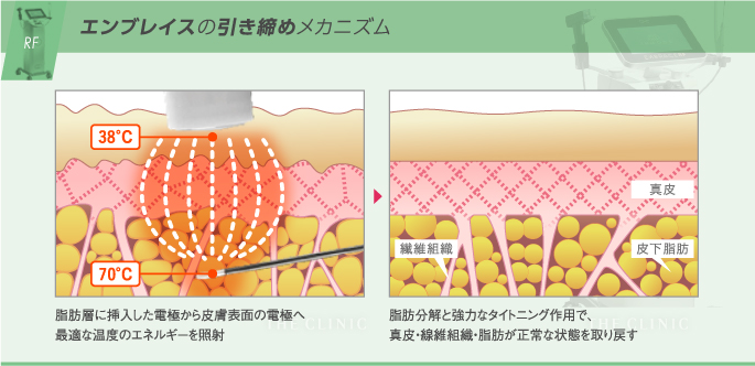 エンブレイスRFがたるみを強力に引き締めるメカニズム