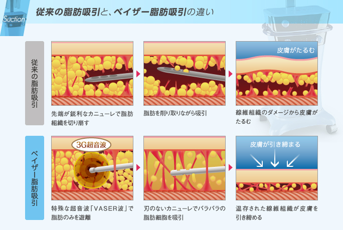 従来の脂肪吸引と、ベイザー脂肪吸引の違い