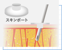 顔の脂肪吸引で使用するスキンポート
