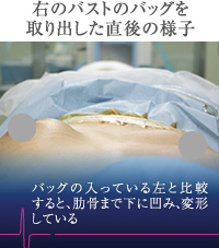 シリコンバッグを除去した直後の様子